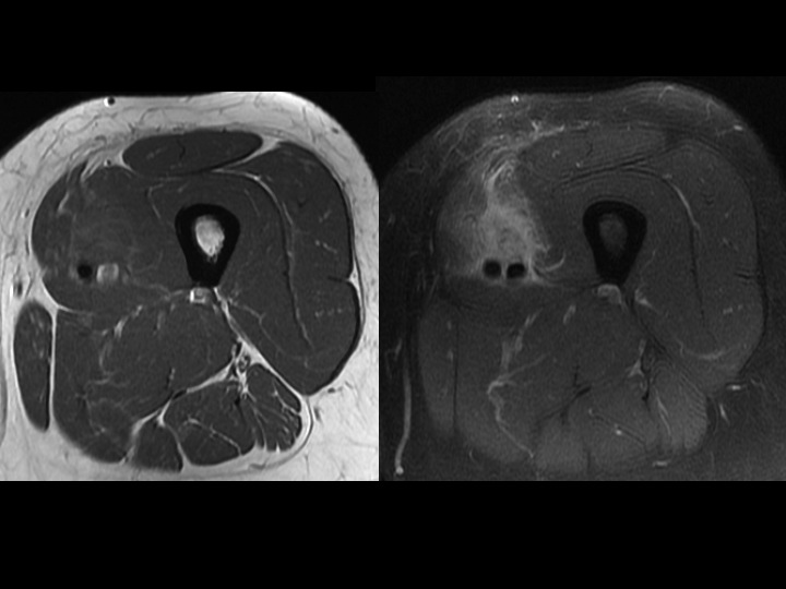 Figure 3 for case myositis ossificans